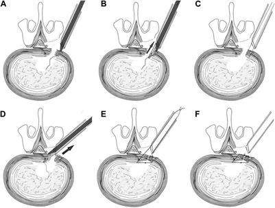 Ex-vivo biomechanical evaluation of the application of a novel annulus closure device to closure of annulus fibrosus